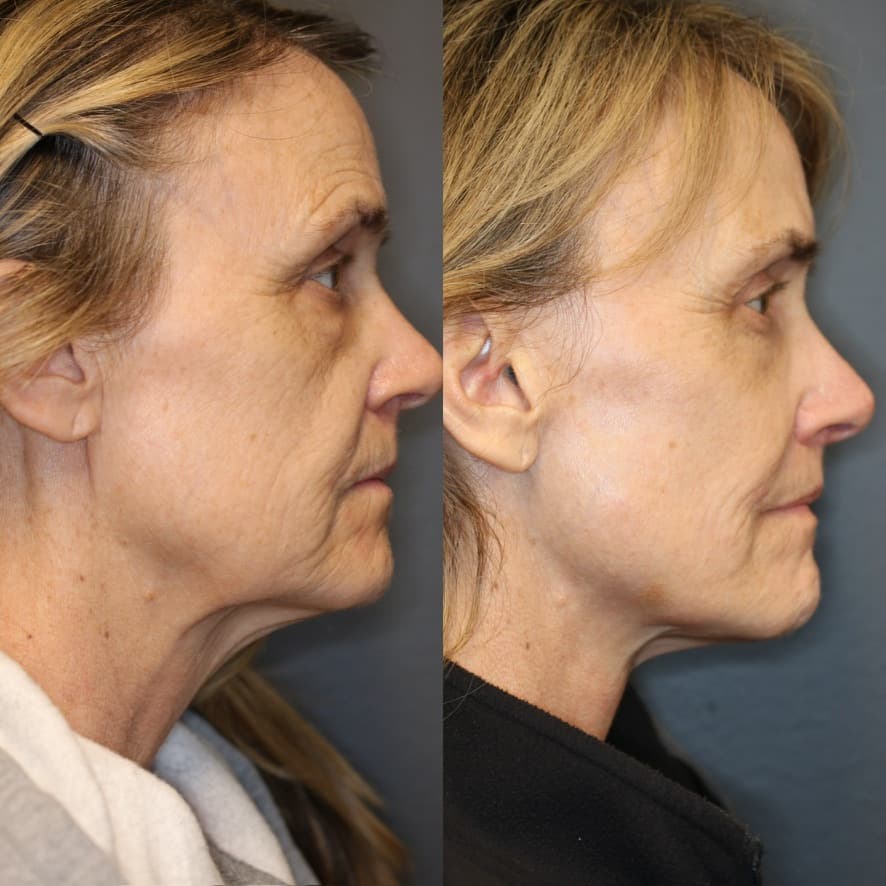 Deep Plane Face and Neck Lift