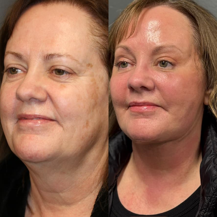 Deep Plane Face and Neck Lift
