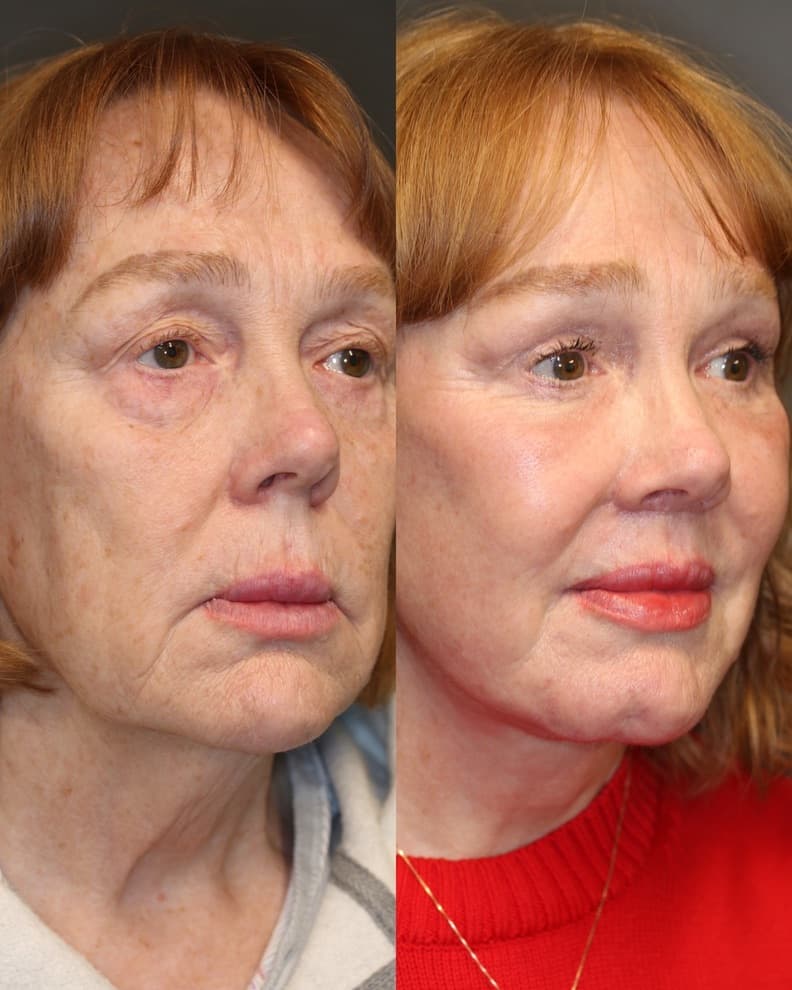 Deep Plane Face and Neck Lift