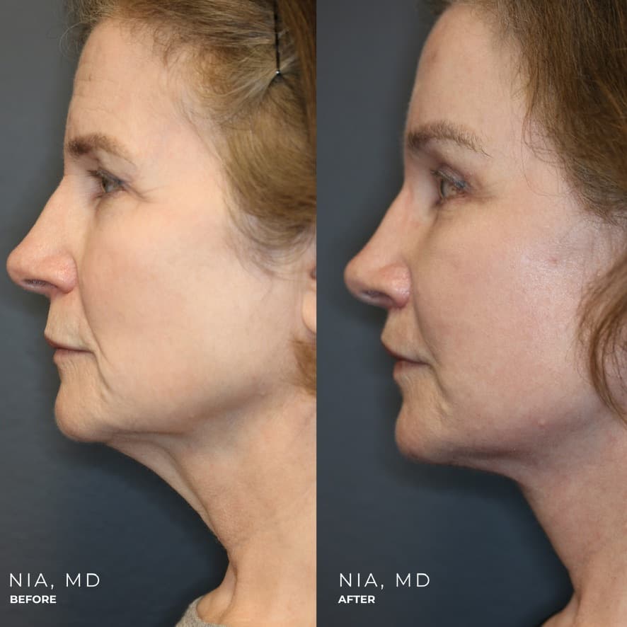 Deep Plane Face and Neck Lift