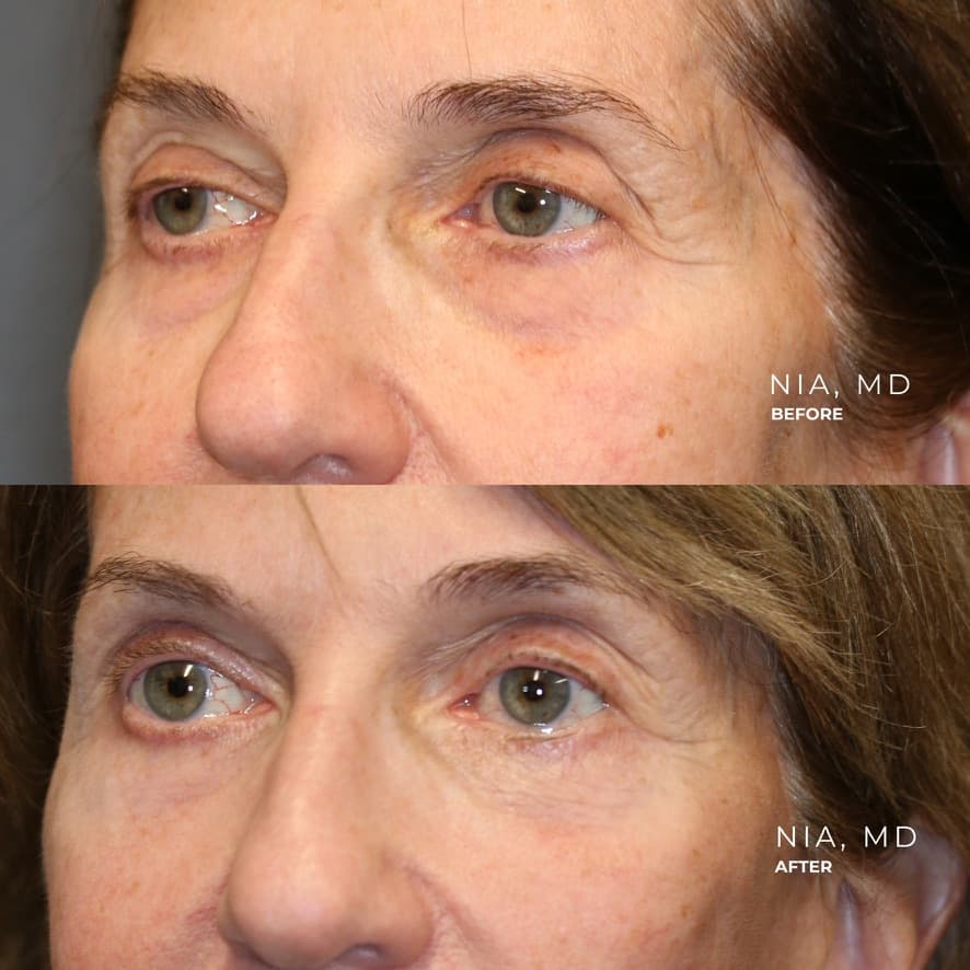 Deep Plane Face and Neck Lift