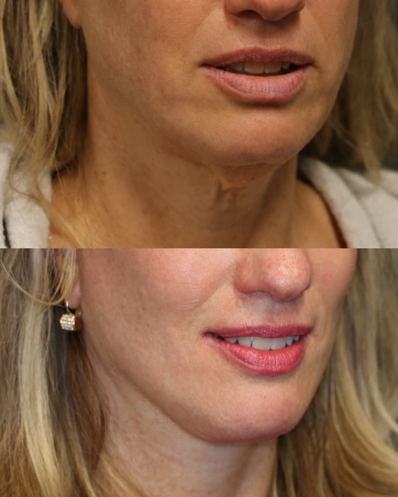Deep Plane Face and Neck Lift
