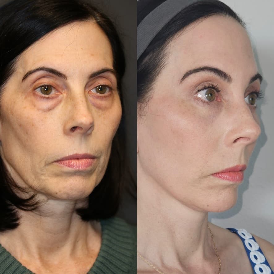 Comprehensive Facial Rejuvenation