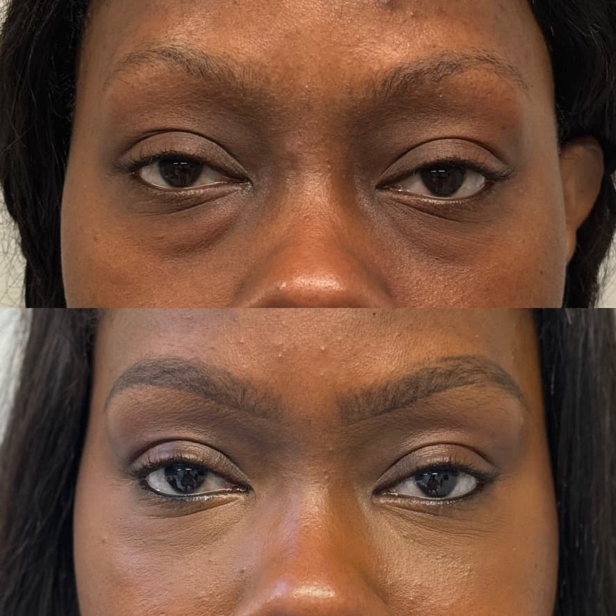 Lower Blepharoplasty