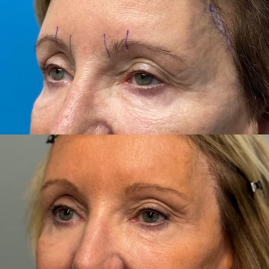 Upper and Lower Blepharoplasty
