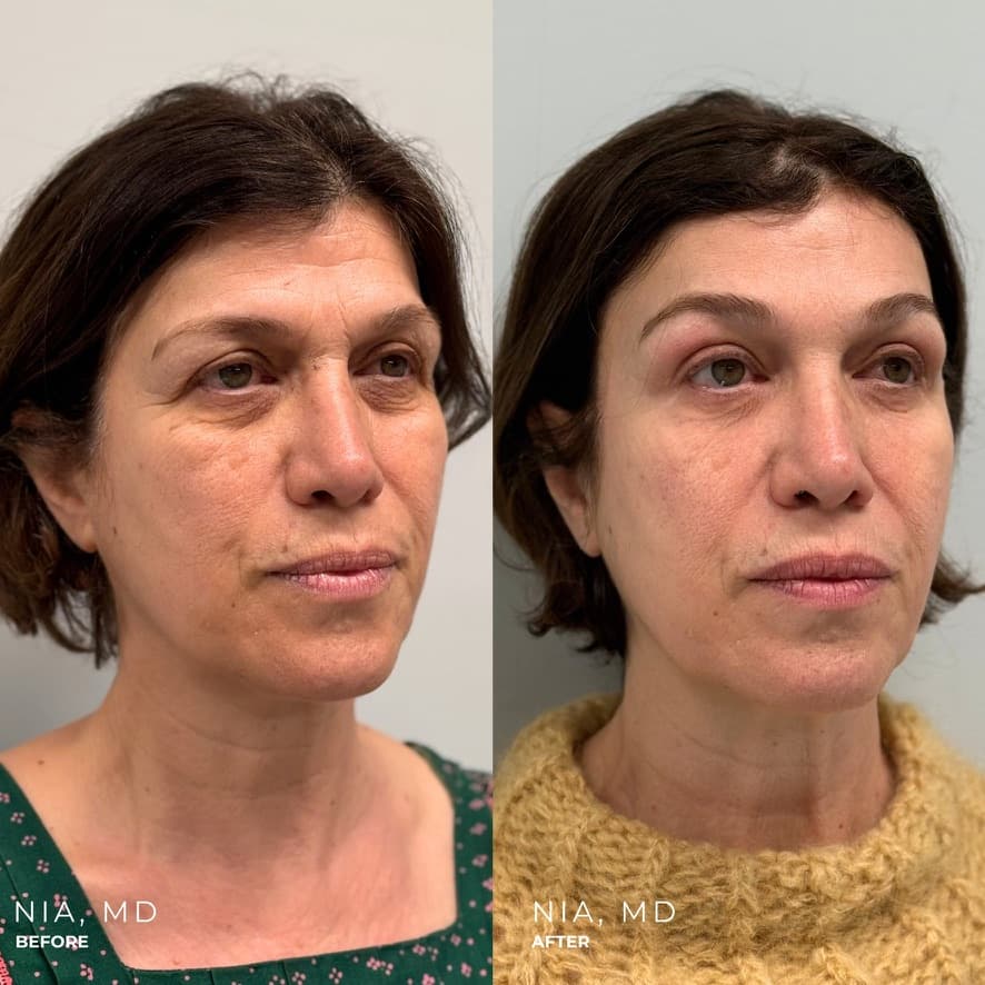 Upper and Lower Blepharoplasty