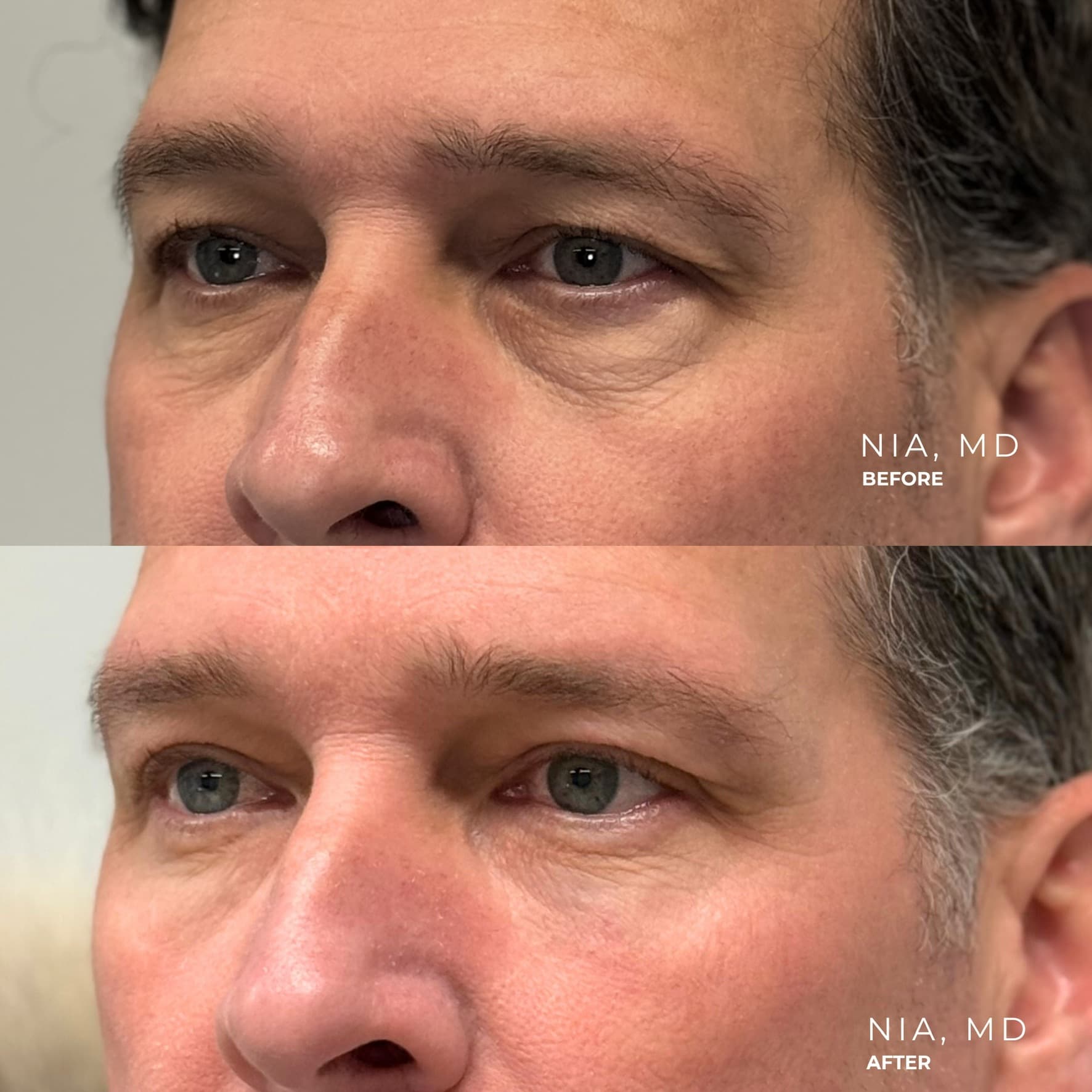 Eyelid and Brow
