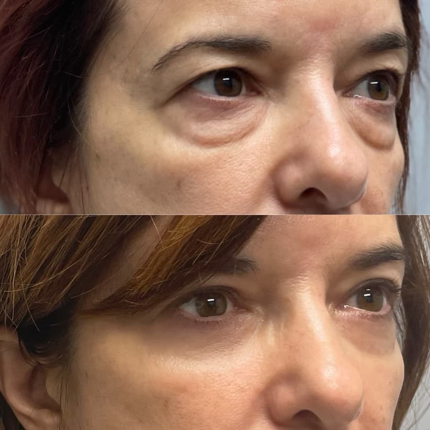 Upper and Lower Blepharoplasty