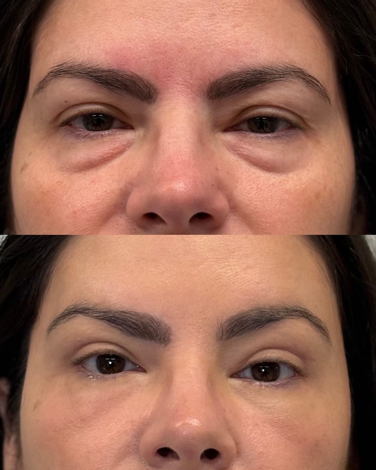 Upper and Lower Blepharoplasty