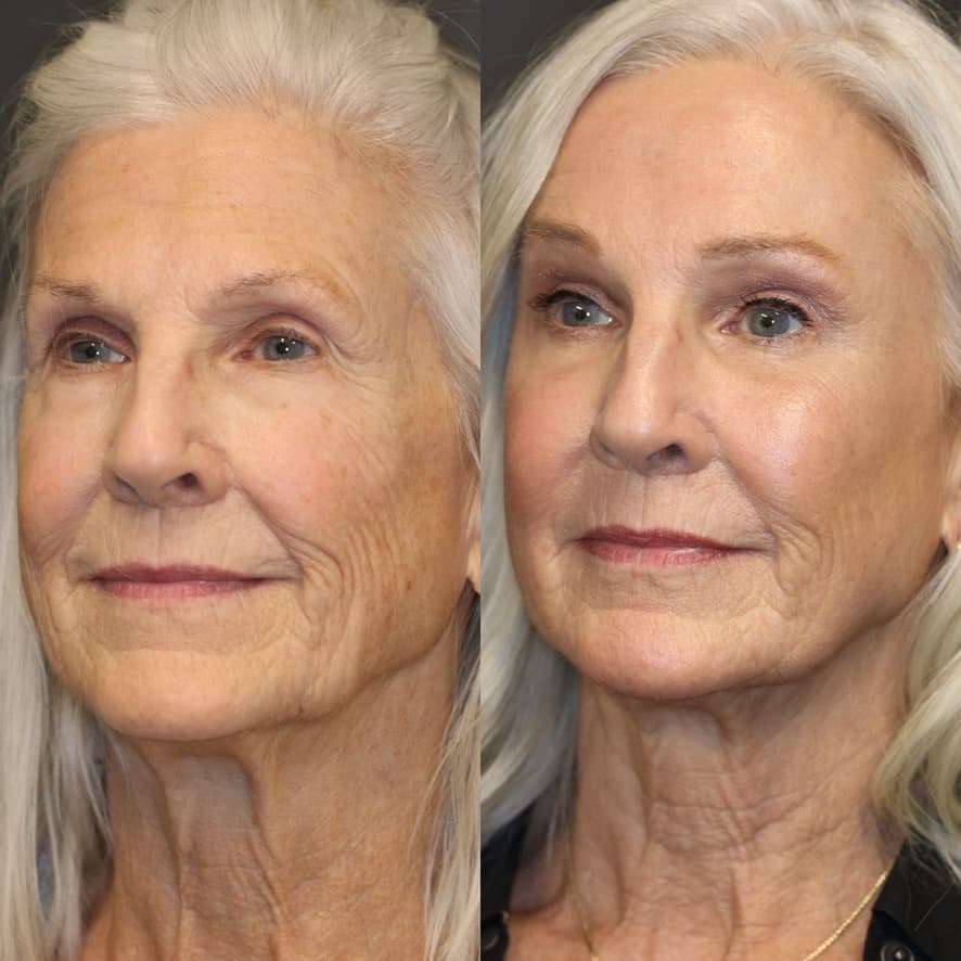 Upper and Lower Blepharoplasty