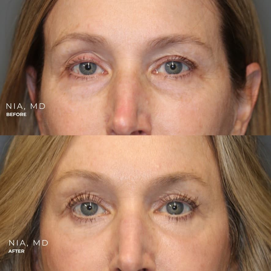 Upper and Lower Blepharoplasty