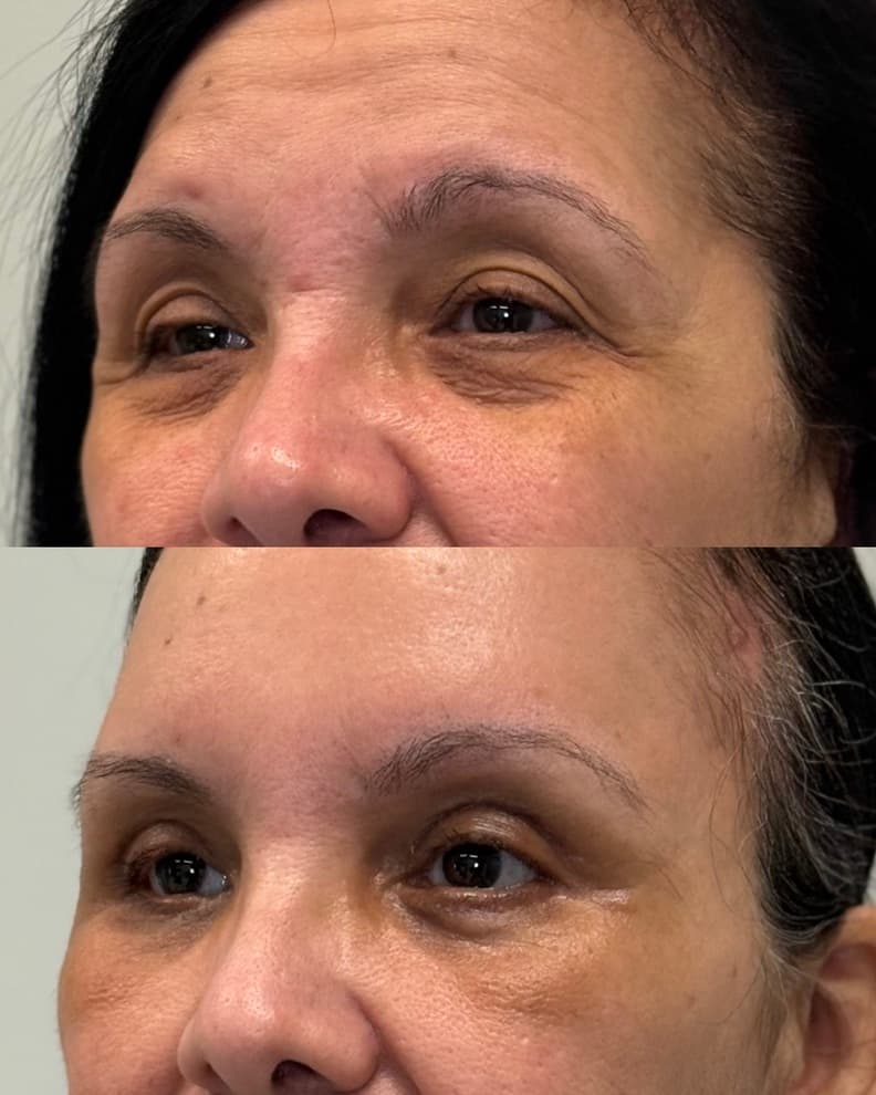 Upper and Lower Blepharoplasty