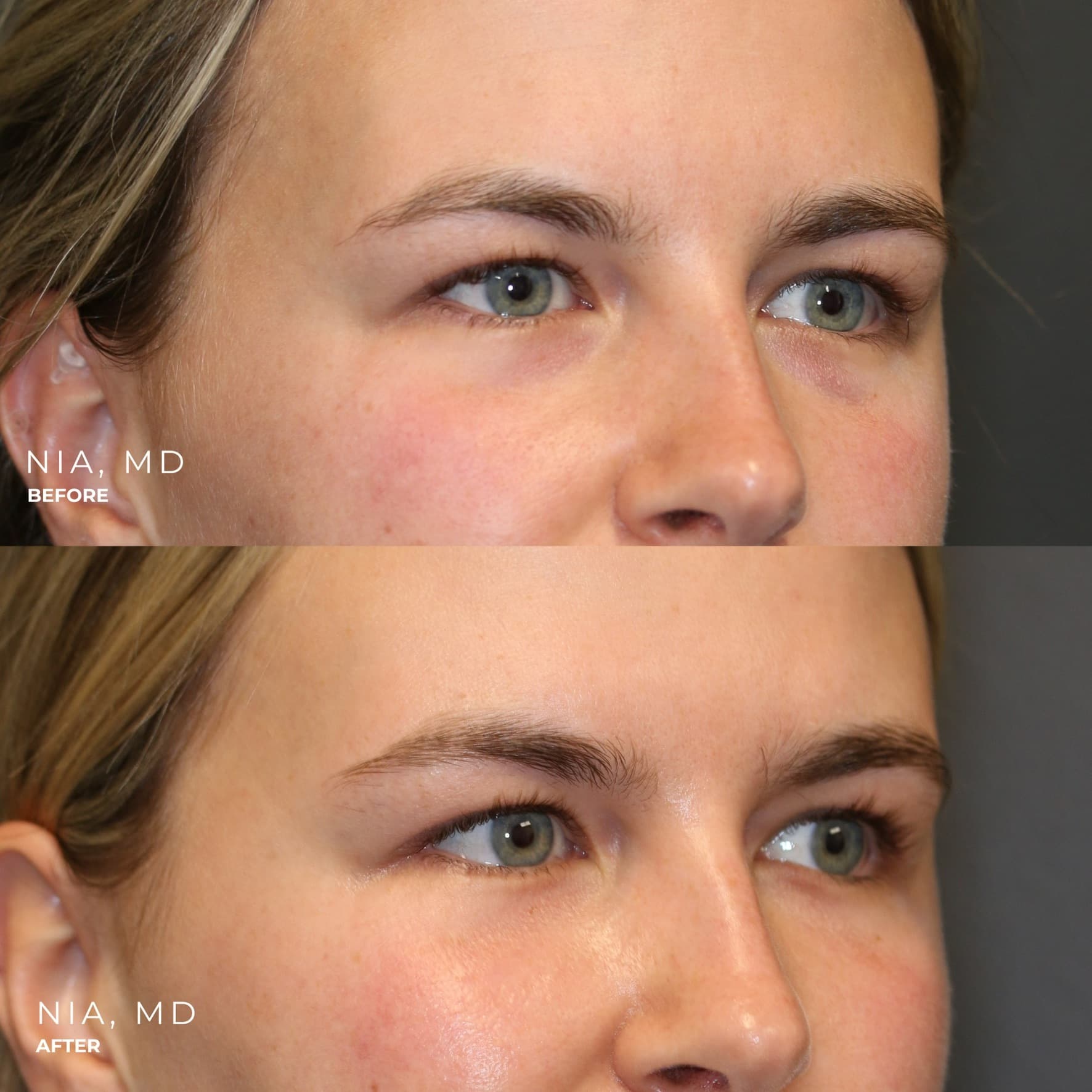 Upper and Lower Blepharoplasty