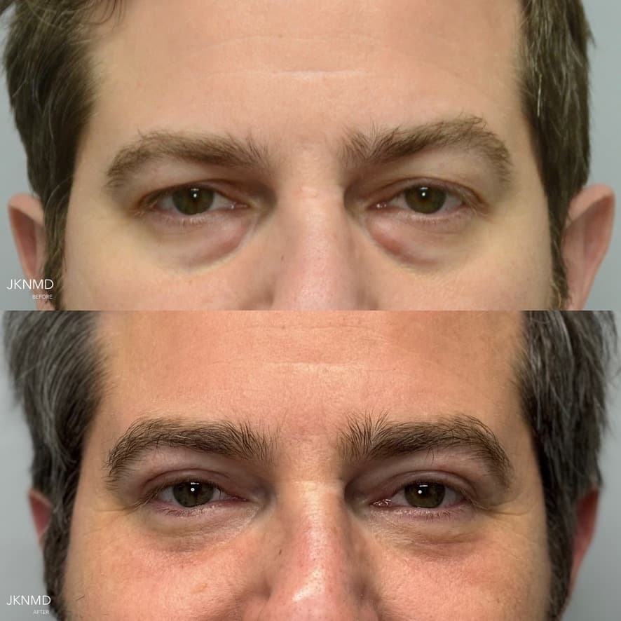 Upper and Lower Blepharoplasty