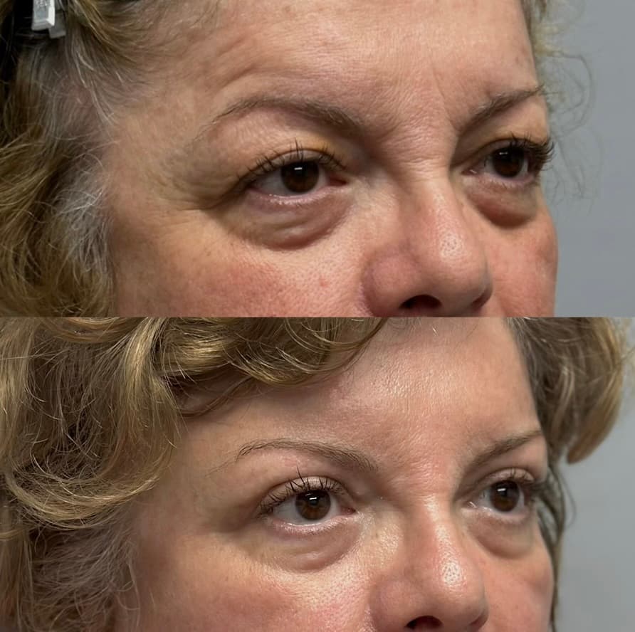 Eyelid Rejuvenation