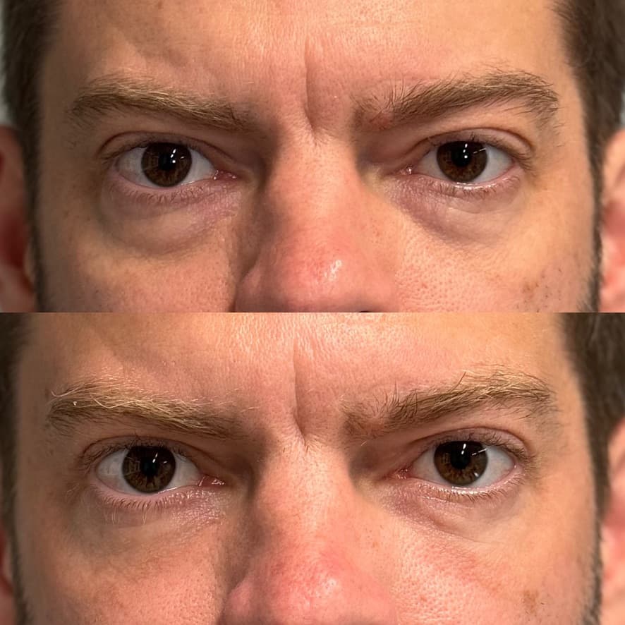 Upper and Lower Blepharoplasty