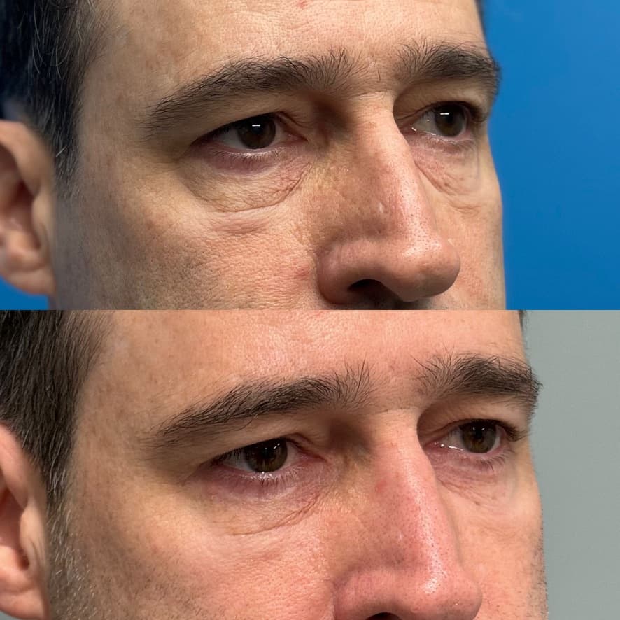 Upper and Lower Blepharoplasty