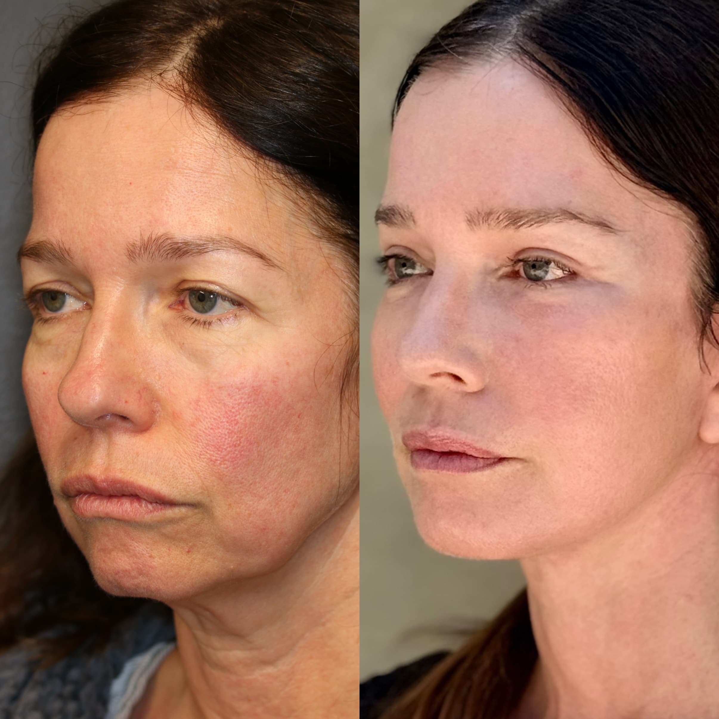 3/4 view — 10 weeks post-procedure