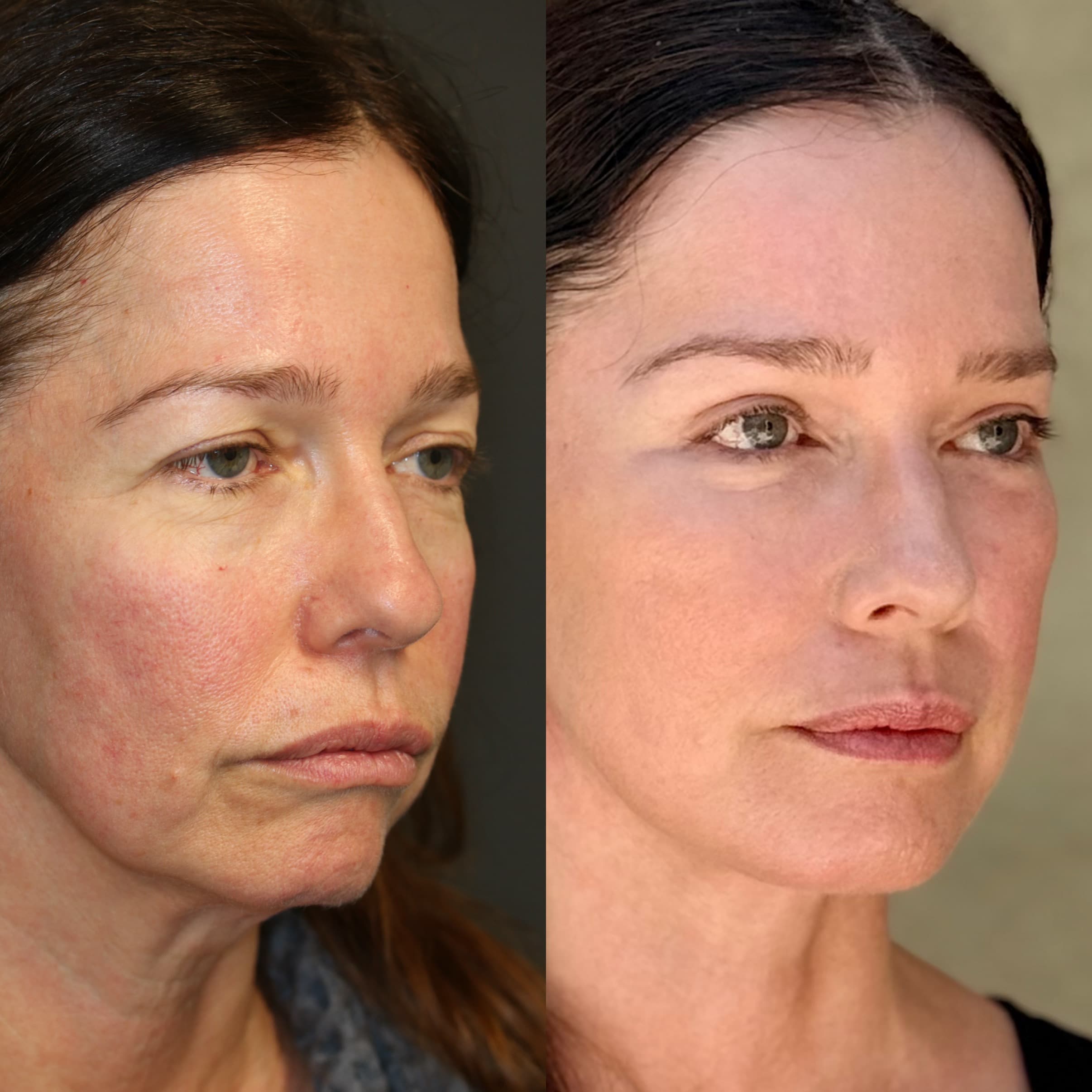 3/4 angle — 10 weeks post-procedure