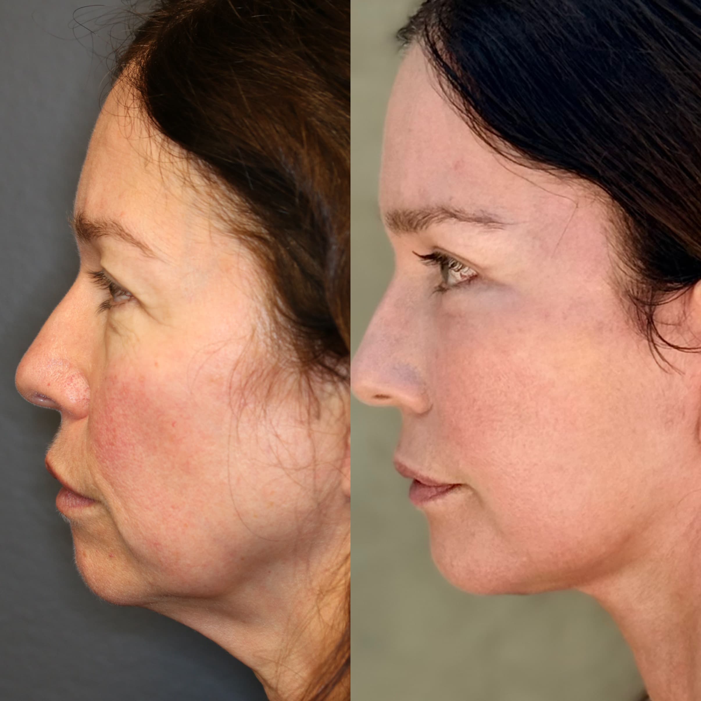 Side profile — 10 weeks post-procedure