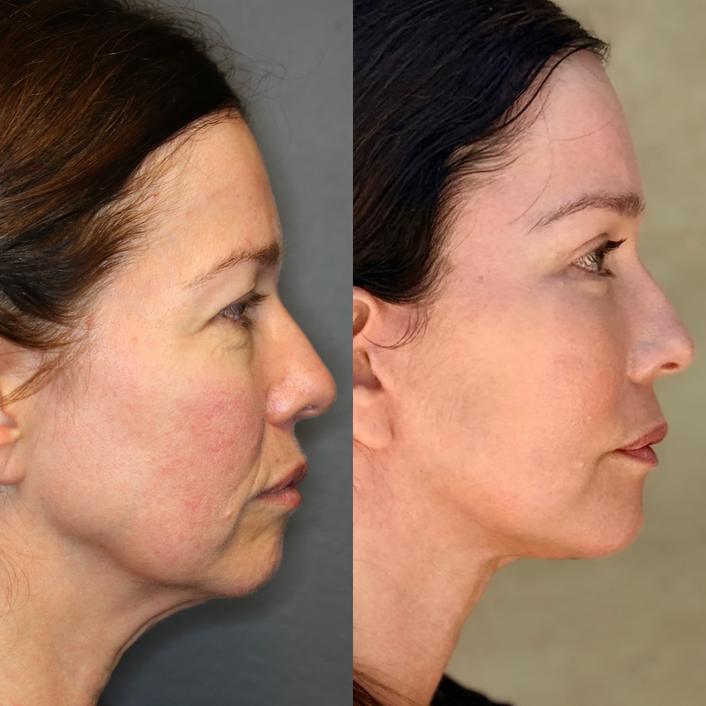 Profile view — 10 weeks post-procedure