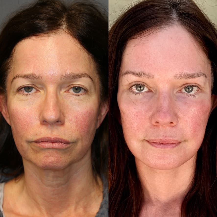 Front view — 1 month post-procedure