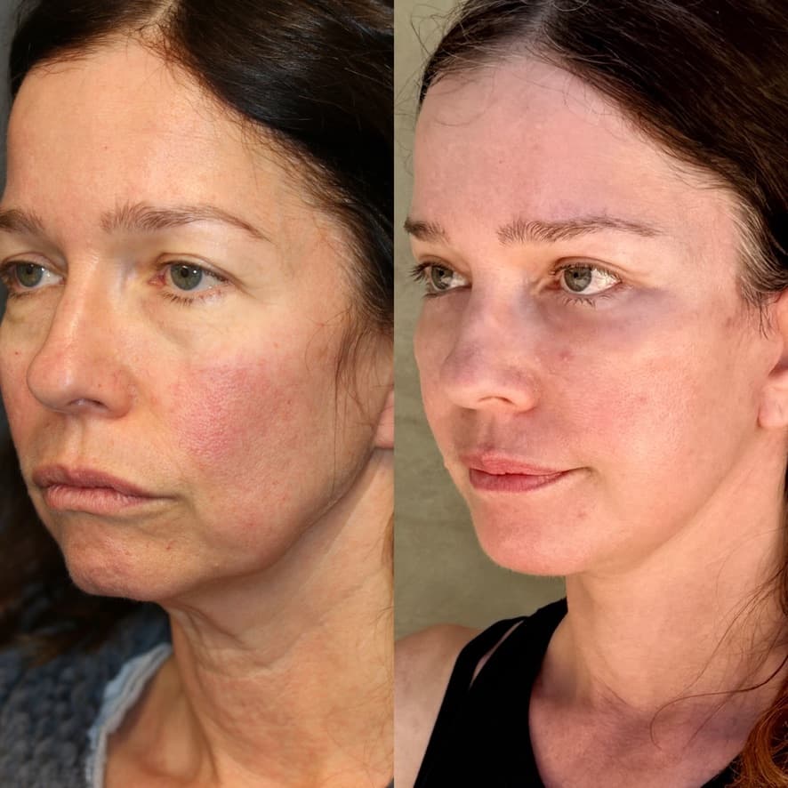 3/4 angle — 1 month post-procedure