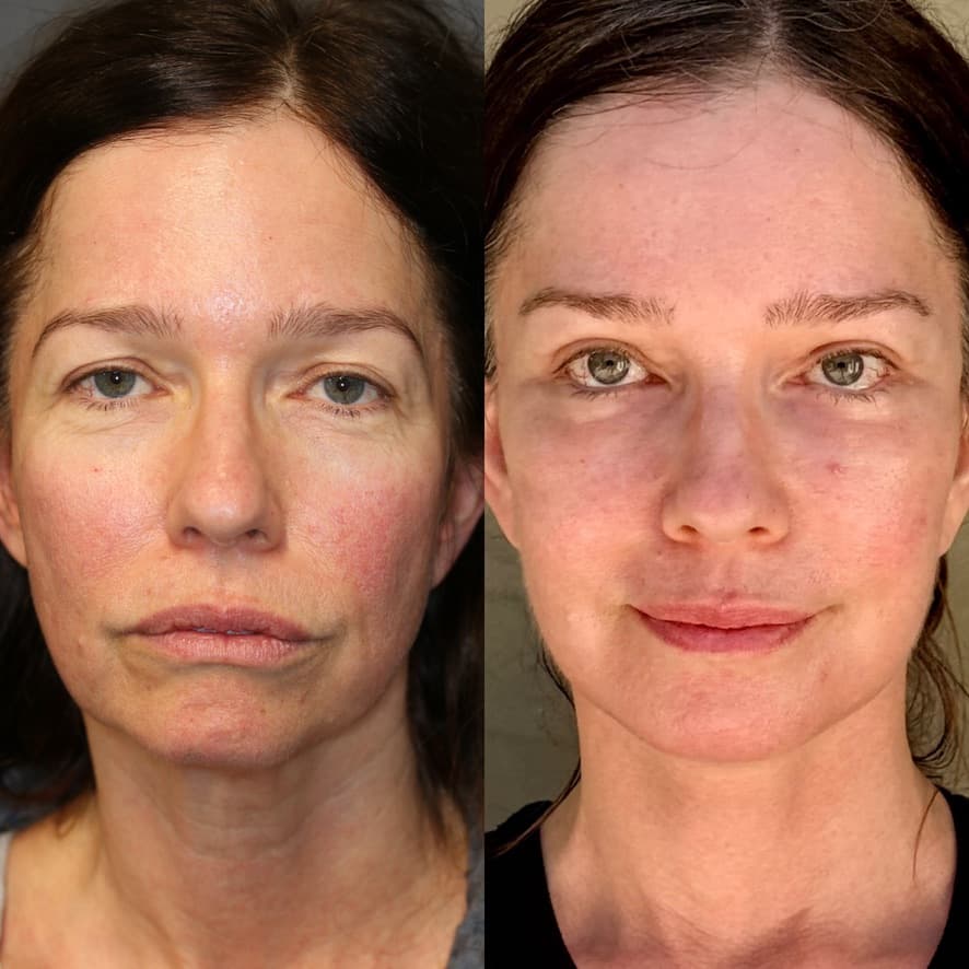 Front view — 1 month post-procedure