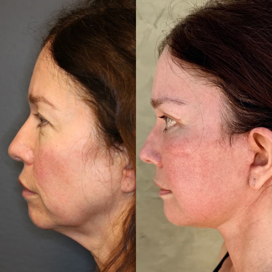 Side profile — 1 month post-procedure