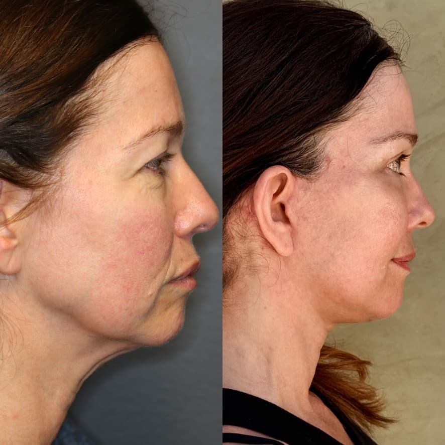 Profile view — 1 month post-procedure