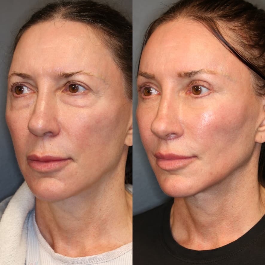 Invisible Access Mid Facelift