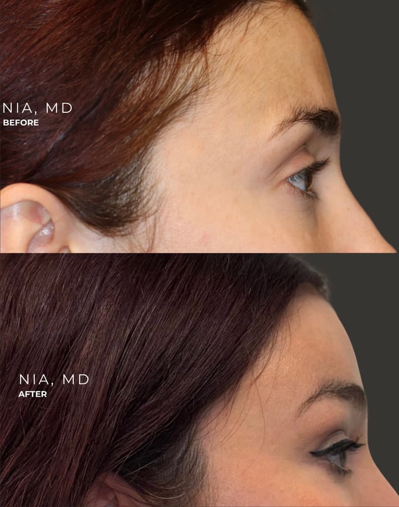Invisible Access Mid Facelift