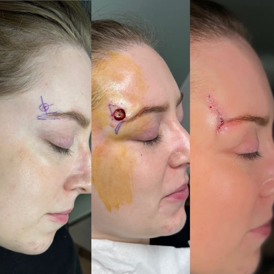 Skin Cancer Reconstruction